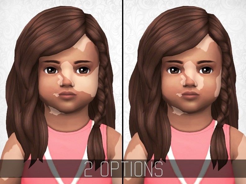 vitiligo-skin-for-toddlers.jpg